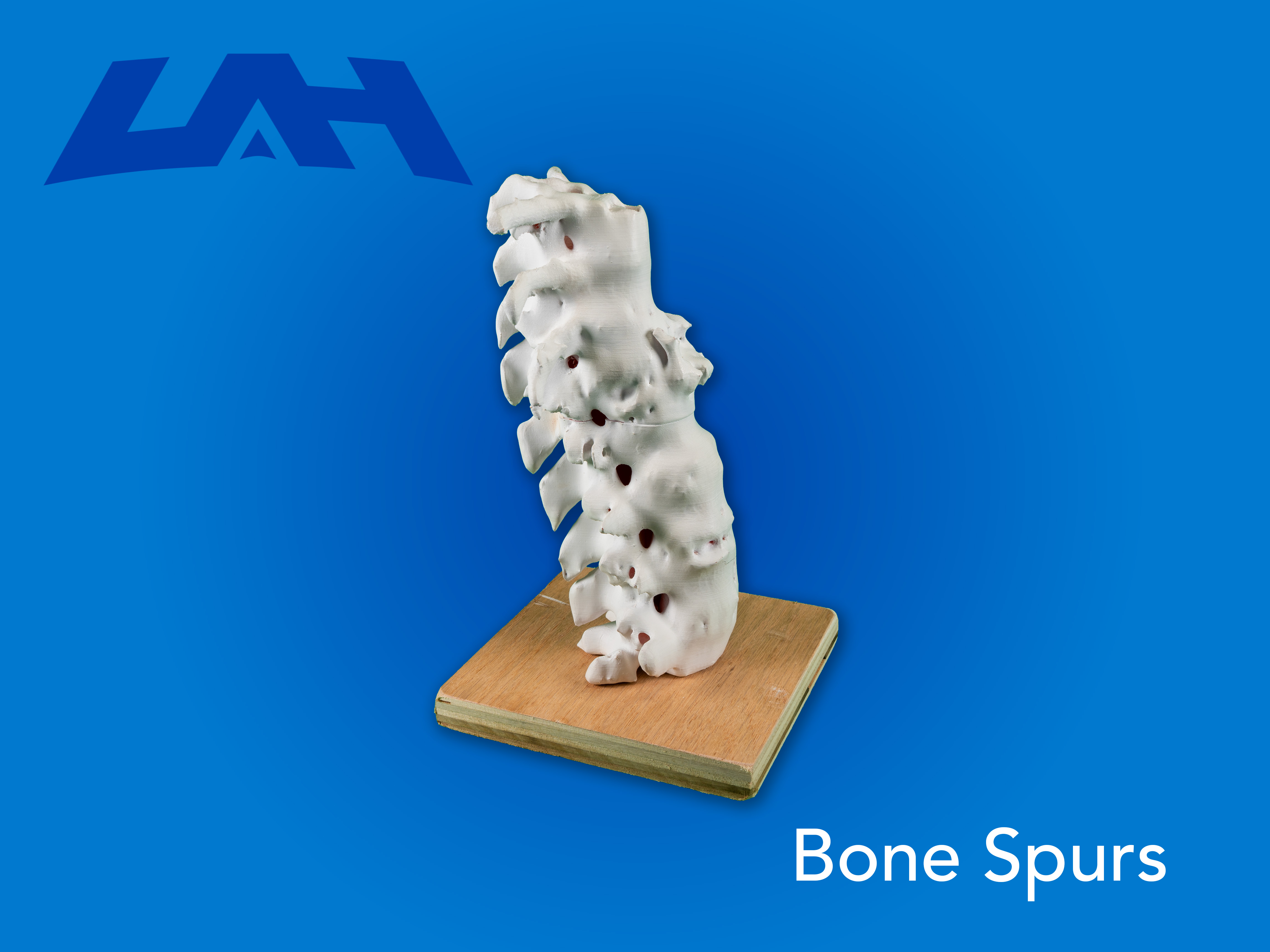 Bone Spurs