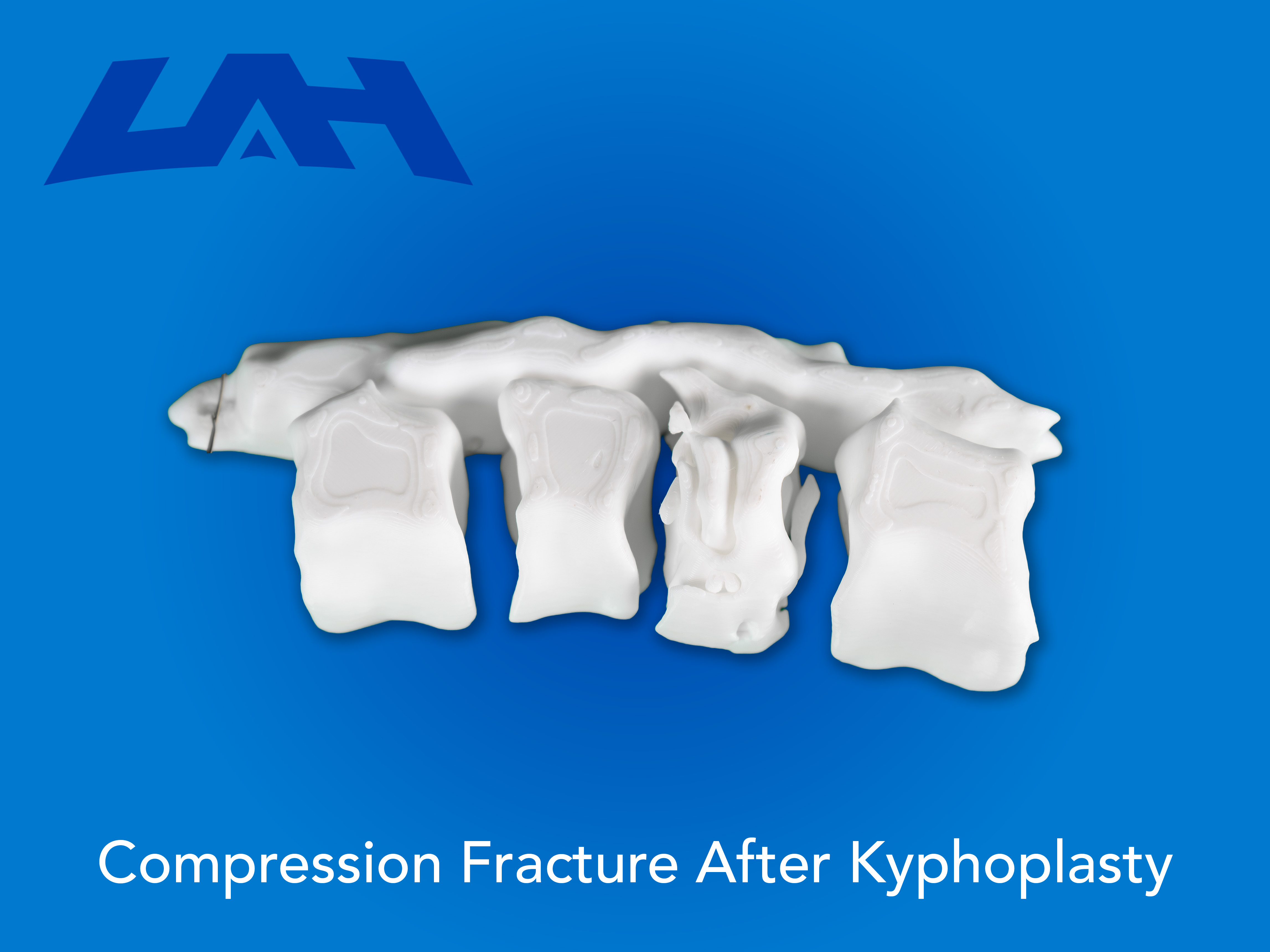 Kyphoplasty