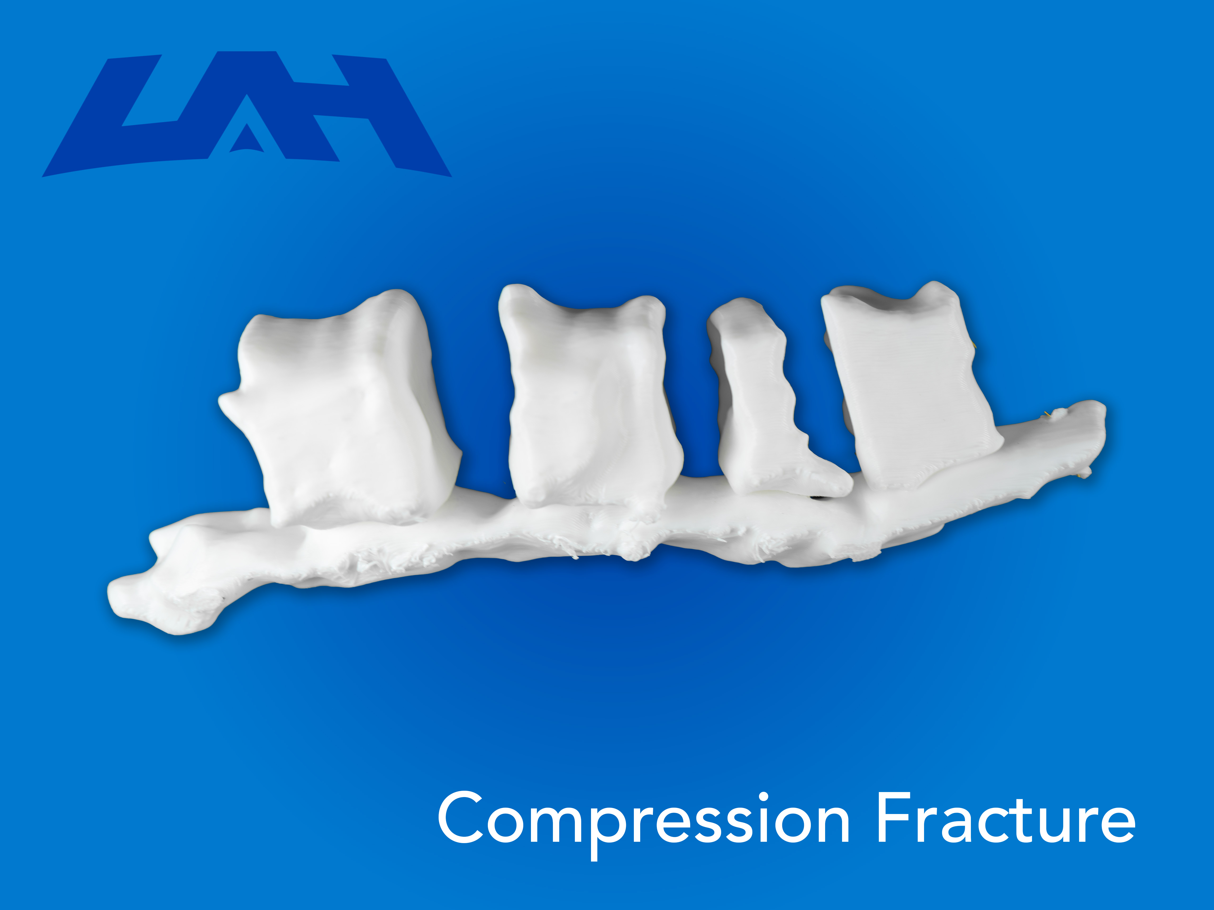 Compression Fracture