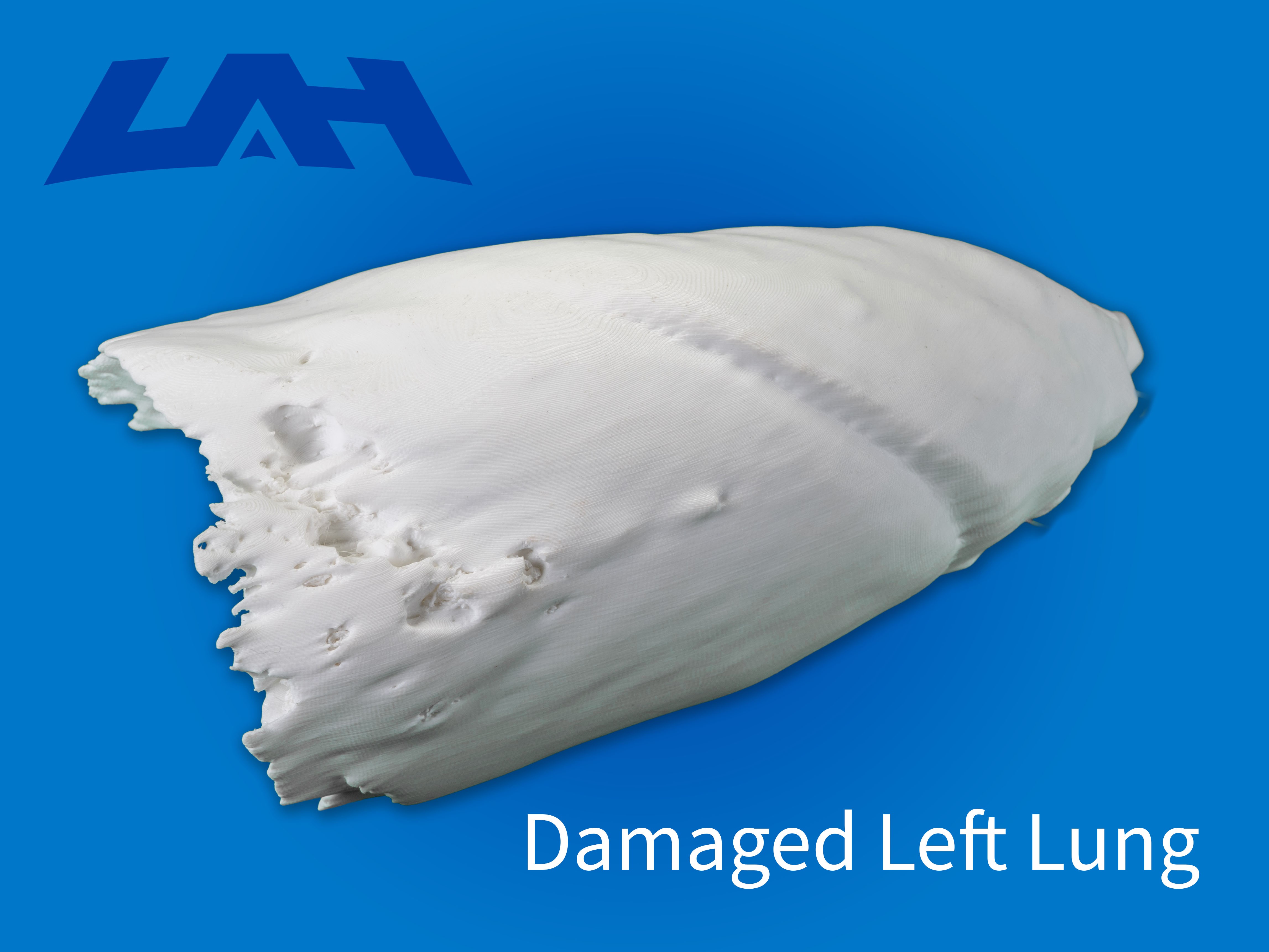 Damaged Left Lung
