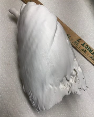 Damaged Left Lung