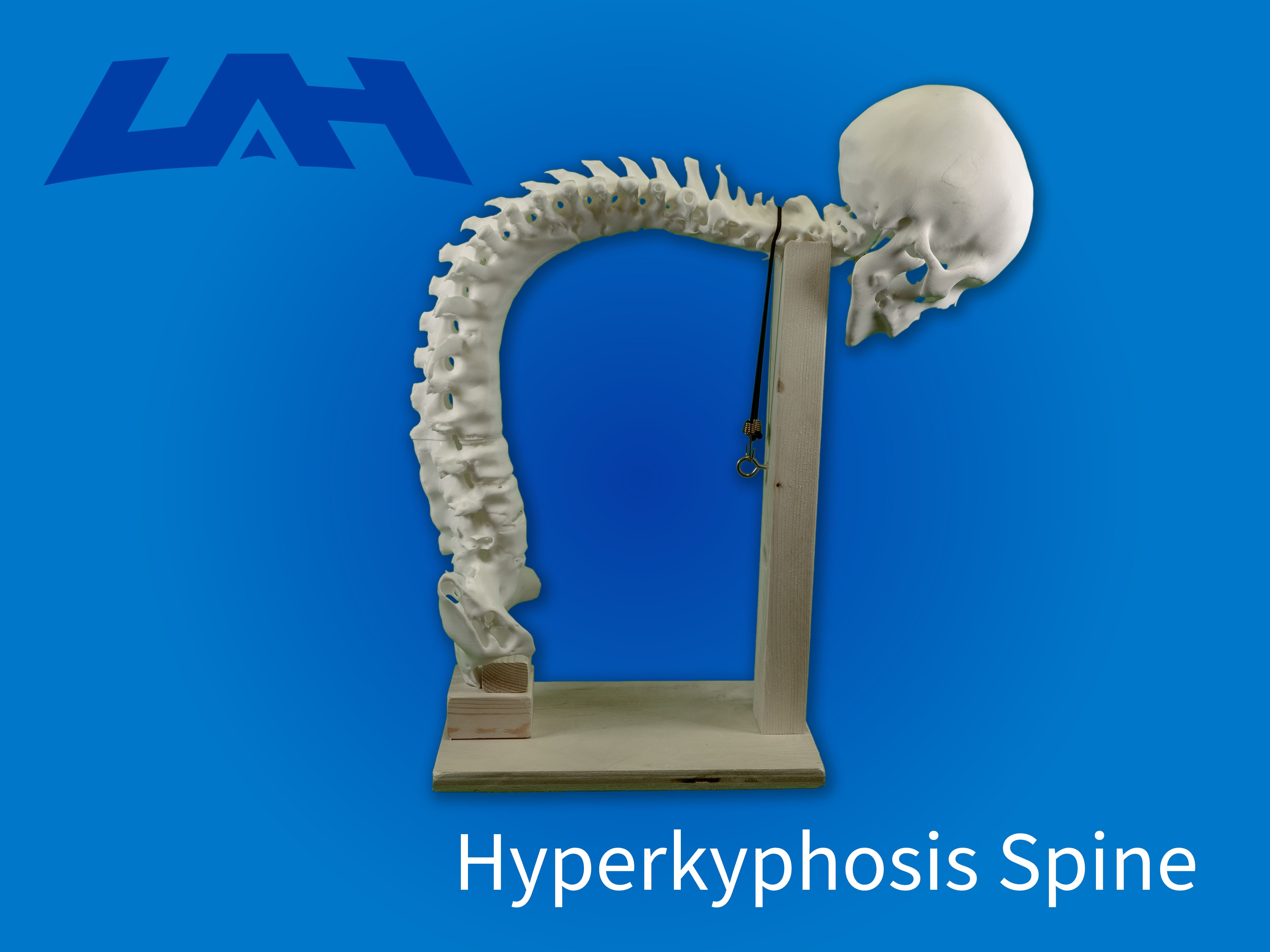 Hyperkyphosis Spine