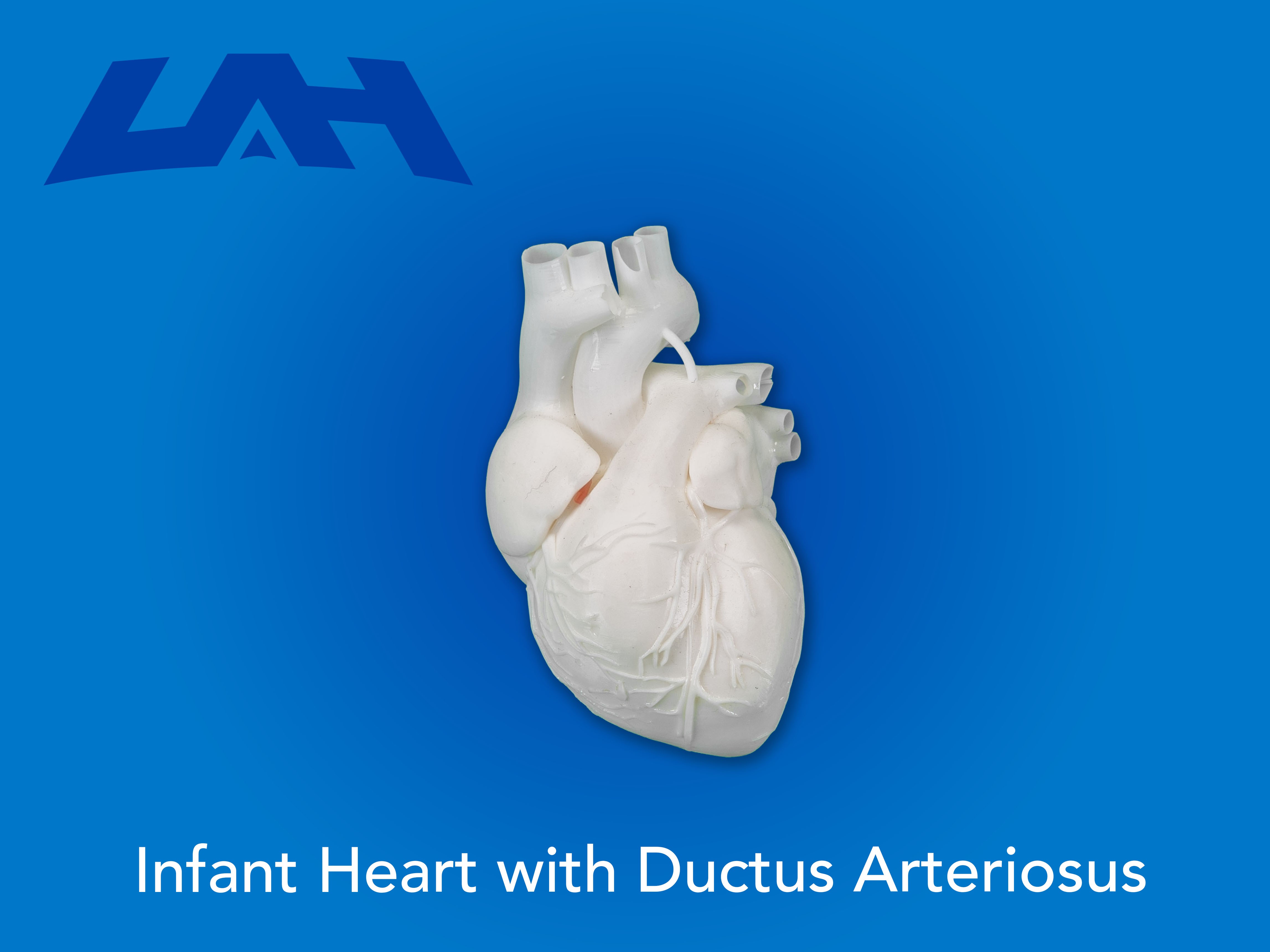 Infant Heart with Ductus Arteriosus