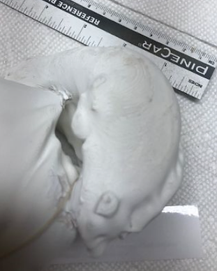 Spleen