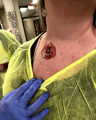 Tattoo Wound