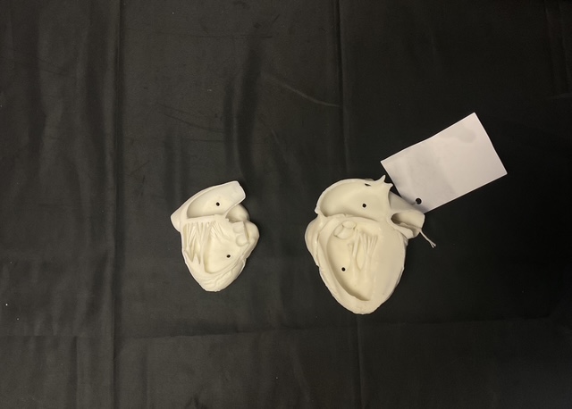 Heart with ASD/VSD