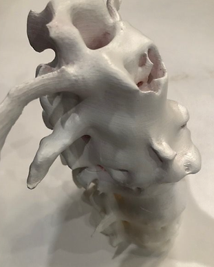 Bone Spurs