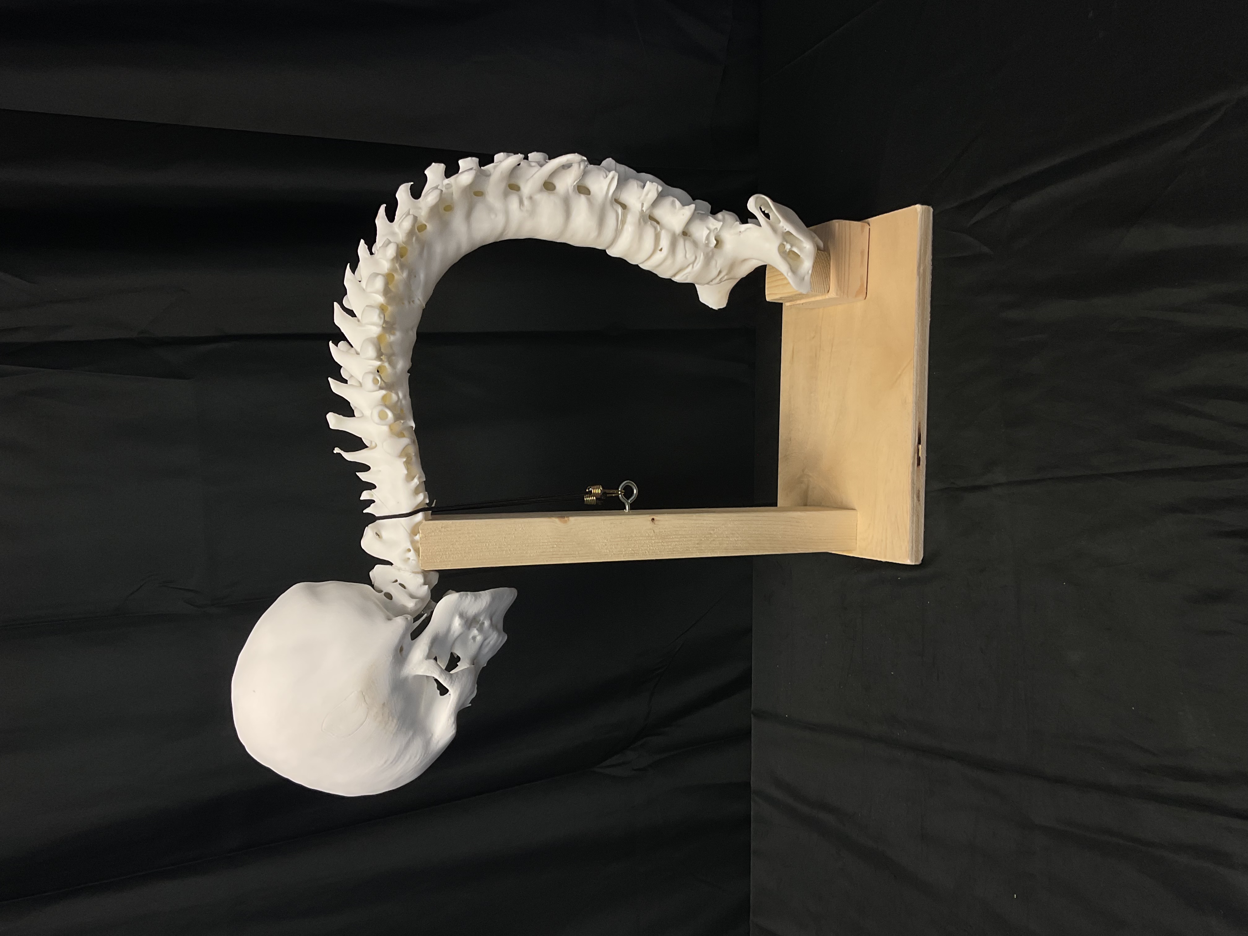 Hyperkyphosis Spine