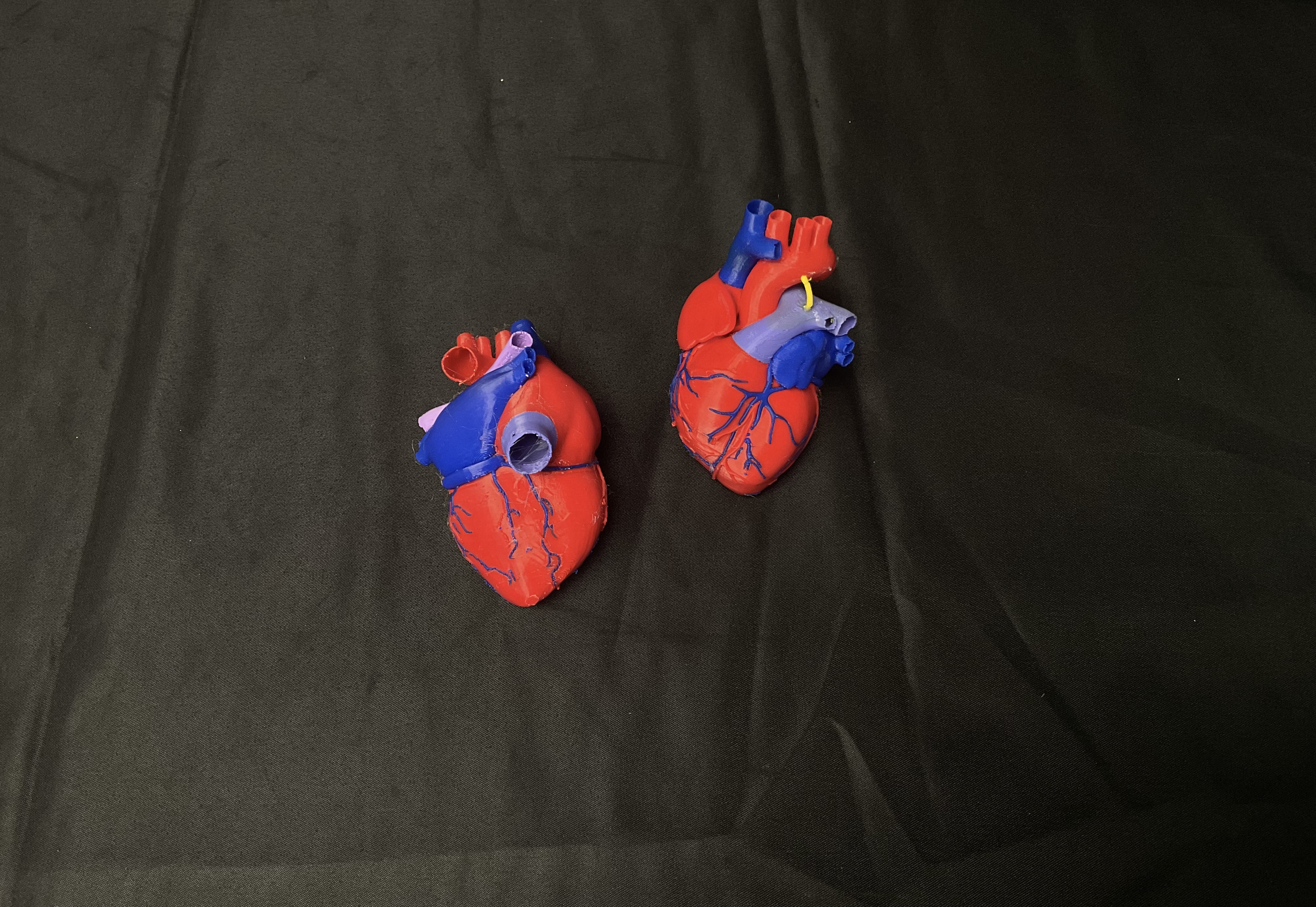 Infant Heart with Ductus Arteriosus